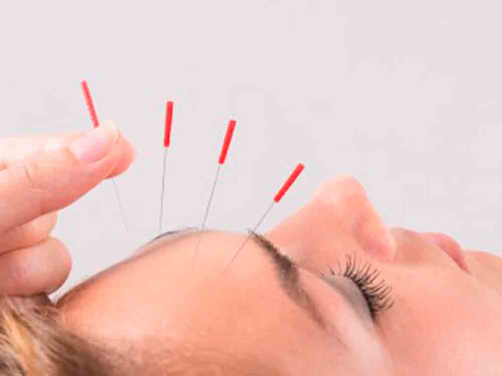 Akupunktur und TCM als wirksame Therapie bei Migräne und Kopfschmerzen
