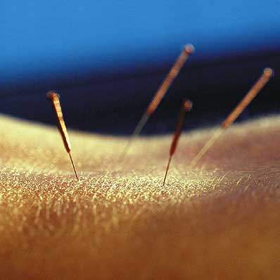 Akupunktur halbiert chronische Schmerzen