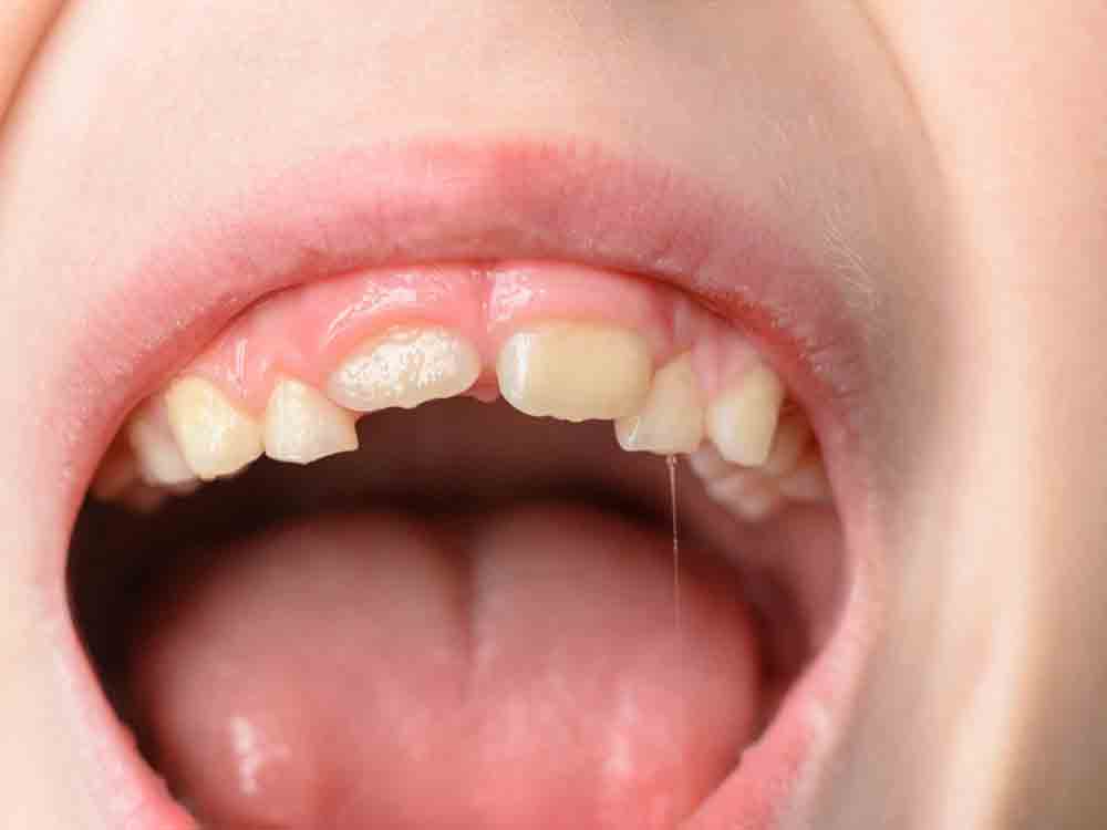 Zahnfehlstellungen und Kieferfehlstellungen, Ursache für ADS und ADHS