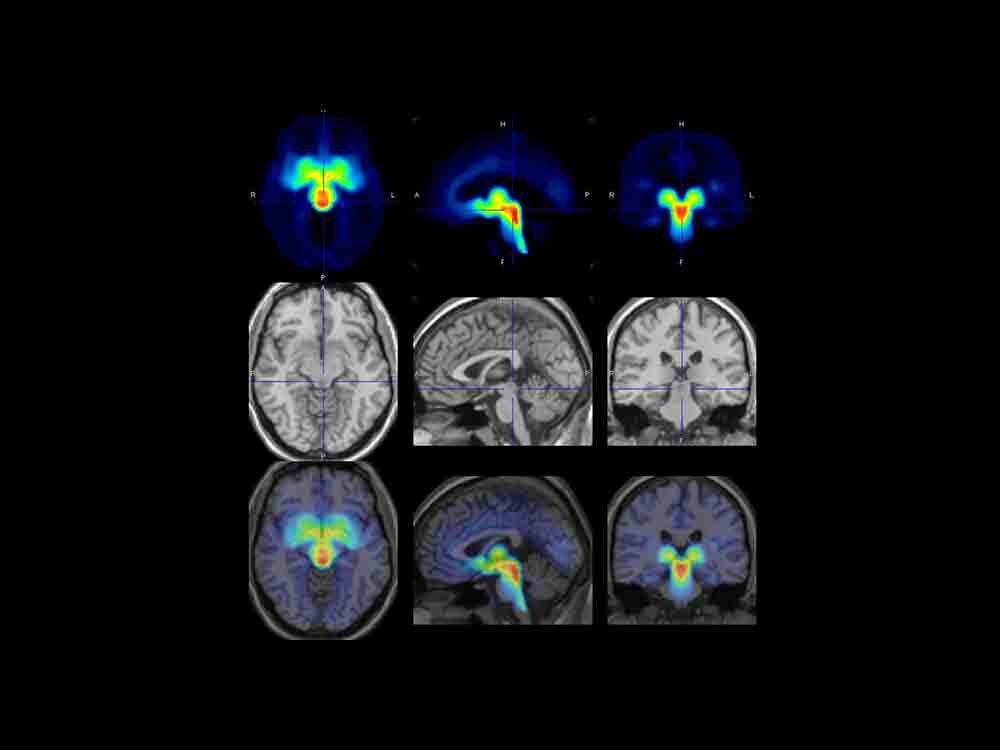 Depression vor den Tagen: Serotonin Transporter im Gehirn erhöht, Max Planck Institut für Kognitionswissenschaften und Neurowissenschaften