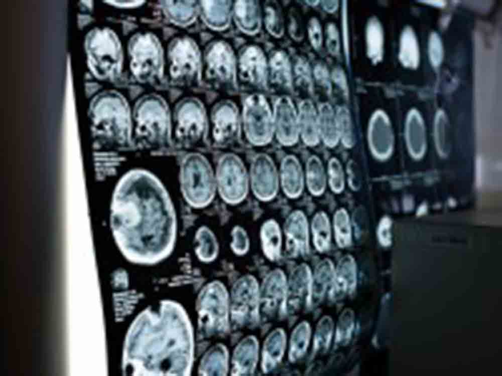 Neues MRT zeigt: Covid 19 verändert das Hirn, »Correlated Diffusion Imaging« erkennt schleichende Veränderungen in der Weißen Substanz