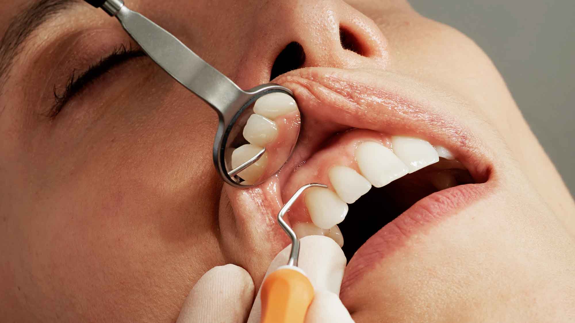 Was leistet meine Kasse bei der professionellen Zahnreinigung?