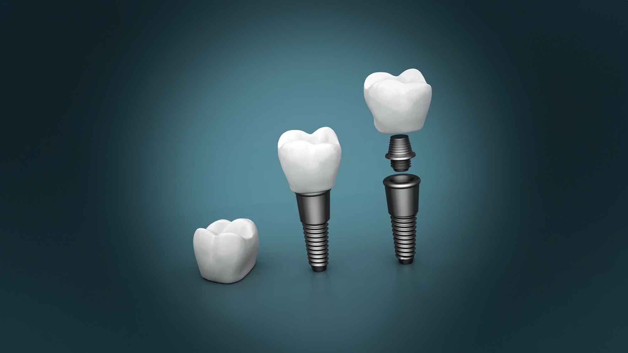 Zahnimplantate: eine moderne Lösung für den Zahnersatz