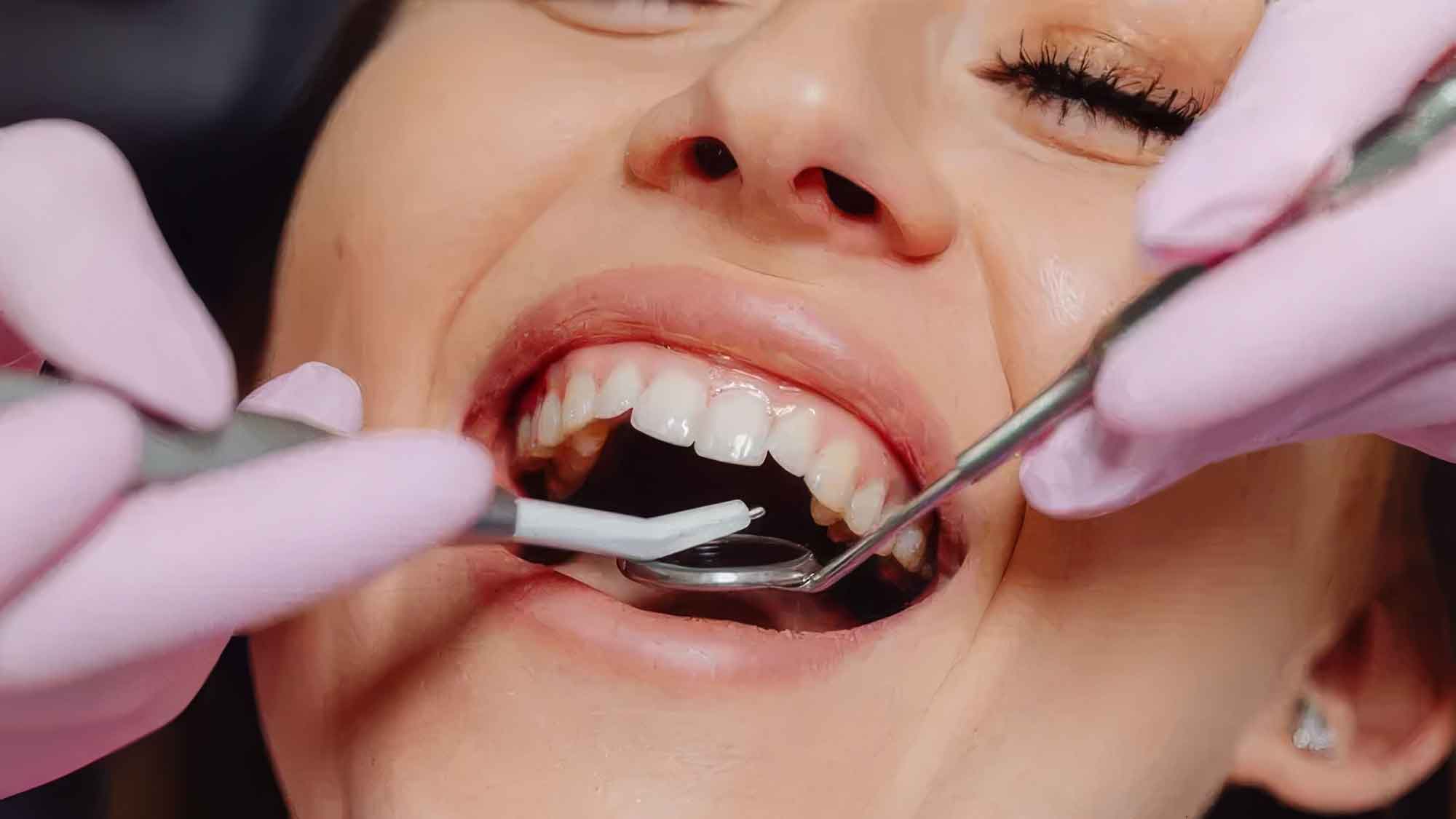 Die häufigsten Ursachen für Zahnverlust und wie man diesen vermeiden kann
